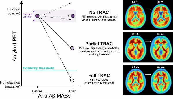 Framework to Improve Alzheimer's Treatment Efficacy by Tracking Anti-Aβ Therapy Response