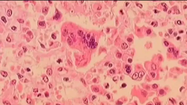 Measles Exposure Warning Issued for Boston and Westborough